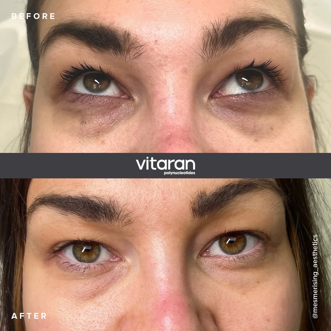 Vitaran I (2 x 1ml) UK