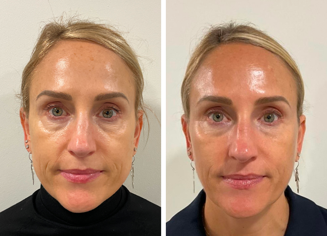 Sunekos Performa (2 x 3.5ml Vials)