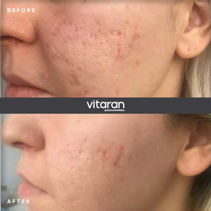 Vitaran II (2x2ml) UK