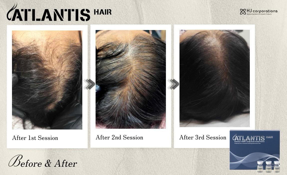 Atlantis Hair (exosomes) 5ml x 10 vials