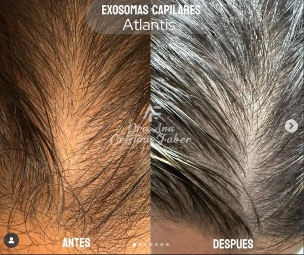 Atlantis Hair (exosomes) 5ml x 10 vials
