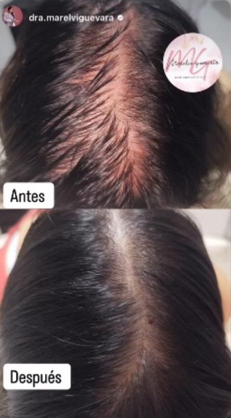 Atlantis Hair (exosomes) 5ml x 10 vials