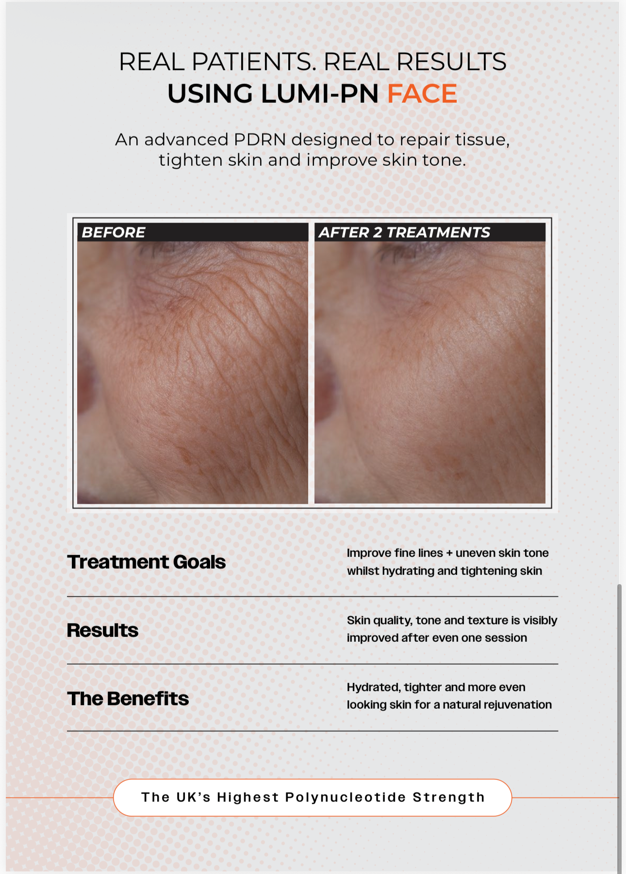 LUMI-PN FACE | 1×2.5ml per pack | Polynucleotide (PDRN) 50mg