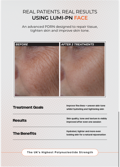 LUMI-PN FACE | 1×2.5ml per pack | Polynucleotide (PDRN) 50mg